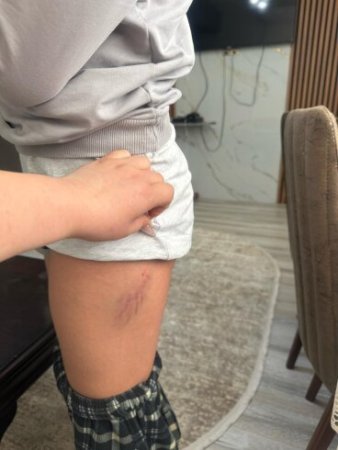 Bu məktəbdə xəsarətlə nəticələnən münaqişə valideyndən GİZLƏDİLDİ - FOTO